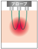 バイポーラ方式のハイパーナイフのイメージ画像